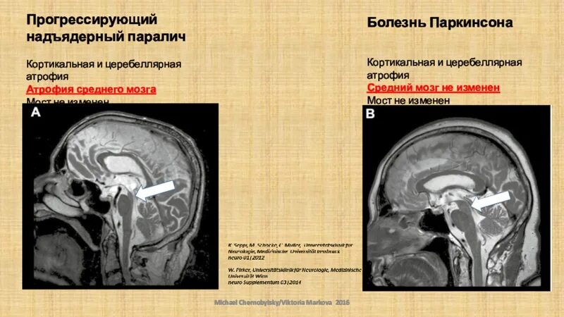 Атрофия головного мозга 1. Прогрессирующий надъядерный паралич мрт. Арогресирующий надядерный папалич. Церебеллярной атрофии на мрт. Кортикальная атрофия головного мозга кт.