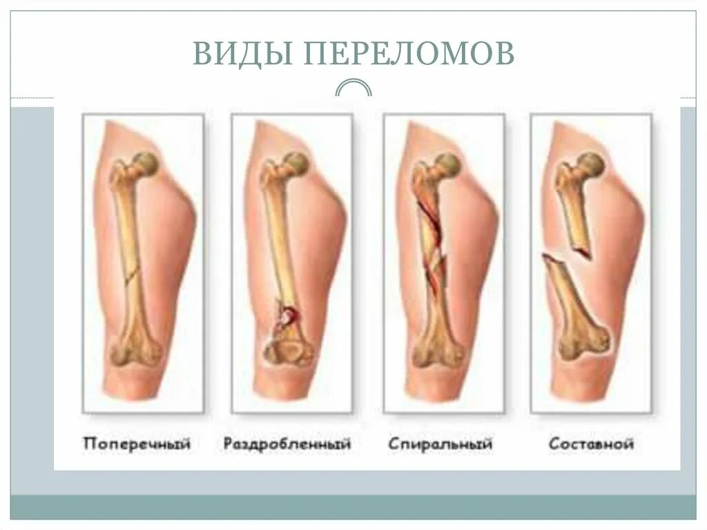 Какие виды переломов бывают. Какие виды переломов бывают