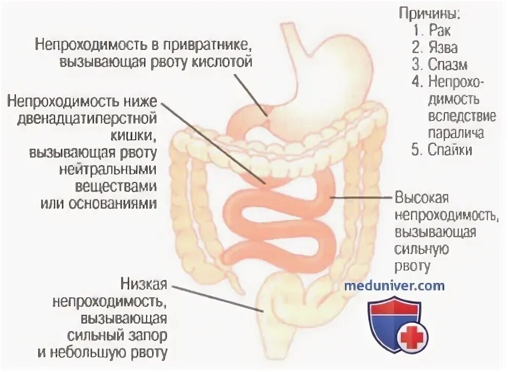 Непроходимость пищеварительного тракта. Непроходимость желудочно кишечного тракта. Непроходимость кишечника. Желудочно кишечная непроходимость.