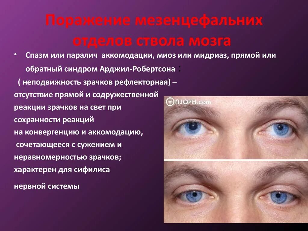 Аккомодация симптомы. Паралич аккомодации. Парез и паралич аккомодации. Спазм и паралич аккомодации. Мидриаз и паралич аккомодации.