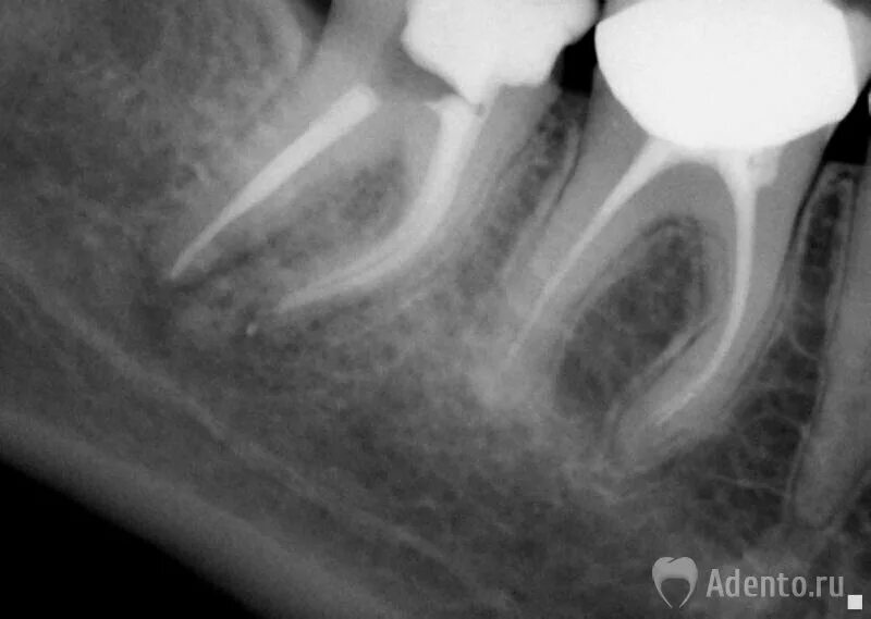 Воспаление канала зуба. Очаговый пульпит рентген. Периапикальный периодонтит. Межкорневой периодонтит. Периодонтит зуба рентген.