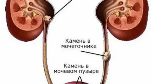 Избавиться от камней в мочевом