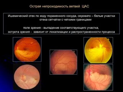 Острая непроходимость центральной артерии