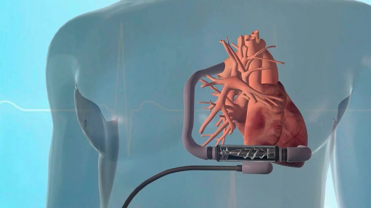 Искусственное сердце. Искусственный левый желудочек сердца. Искусственный желудок. Имплантация искусственного сердца.