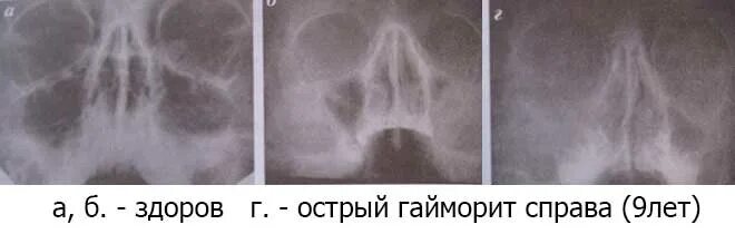 Двухсторонний гнойный. Рентген двустороннего верхнечелюстного синусита. Острый верхнечелюстной синусит на рентгене. Острый правосторонний верхнечелюстной синусит. Одонтогенный верхнечелюстной синусит рентген.