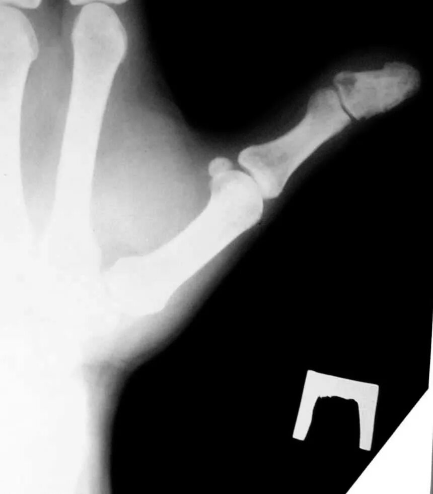 эпифизеолиз ногтевой фаланги. краевой перелом фаланги рентген. перелом дистальной фаланги 1 пальца стопы рентген. перелом ногтевой фаланги 1 пальца. вывих сустава фаланги пальца.