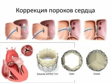 Порок клапана операция