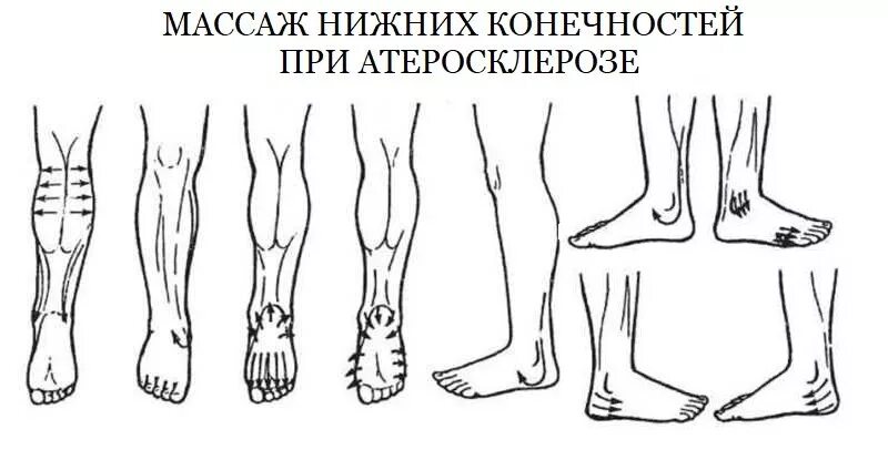 Лечебная физкультура атеросклероза нижних конечностей. Гимнастика при атеросклерозе сосудов нижних конечностей. Массаж ног при атеросклерозе сосудов нижних конечностей. Лечебная гимнастика при атеросклерозе нижних конечностей.