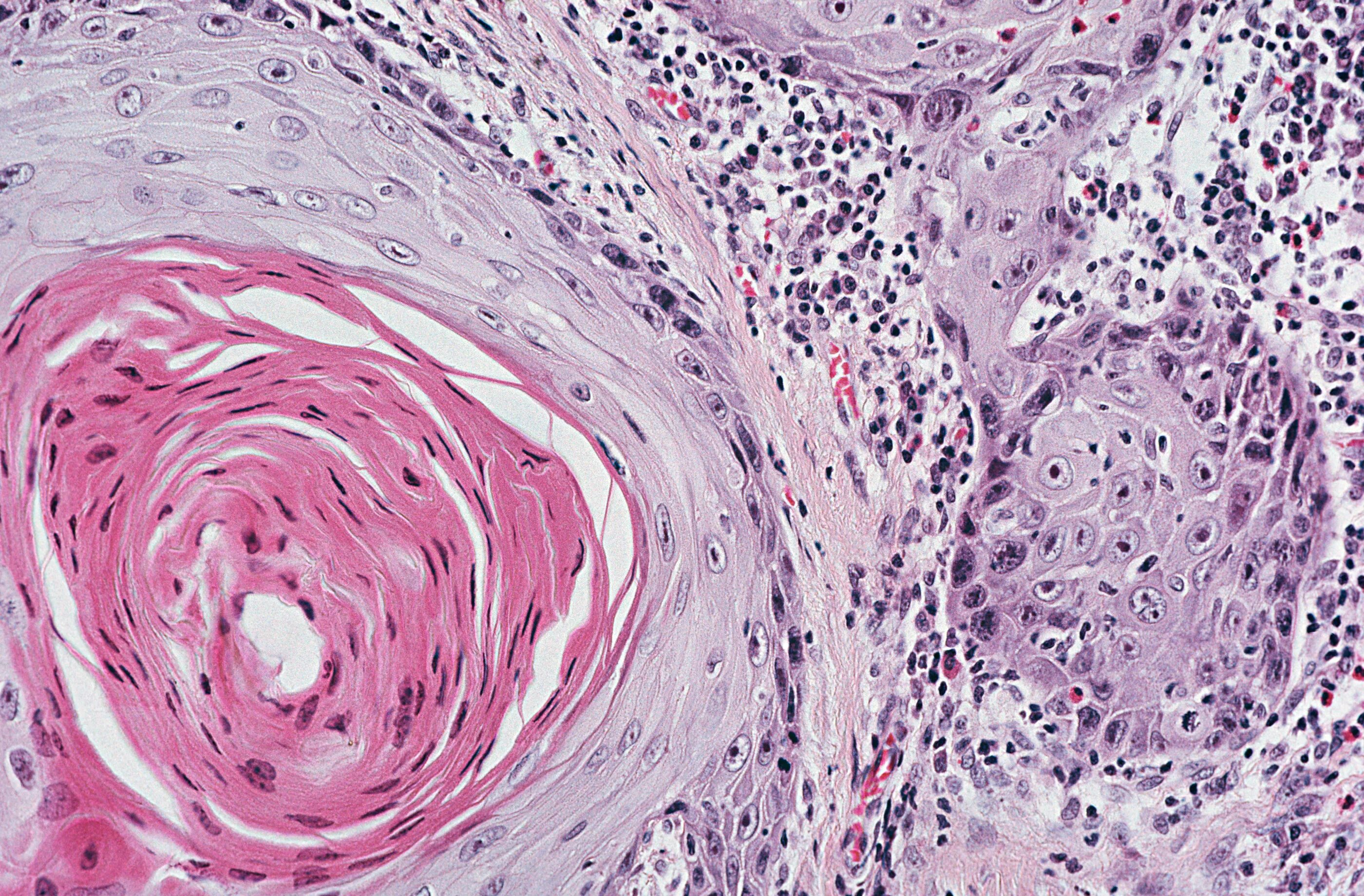 Плоскоклеточная карцинома легкого гистология. Squamous Cell carcinoma гистология. Раковые Жемчужины микропрепарат. Плоскоклеточная карцинома кожи гистология. Низкодифференцированный плоскоклеточный рак