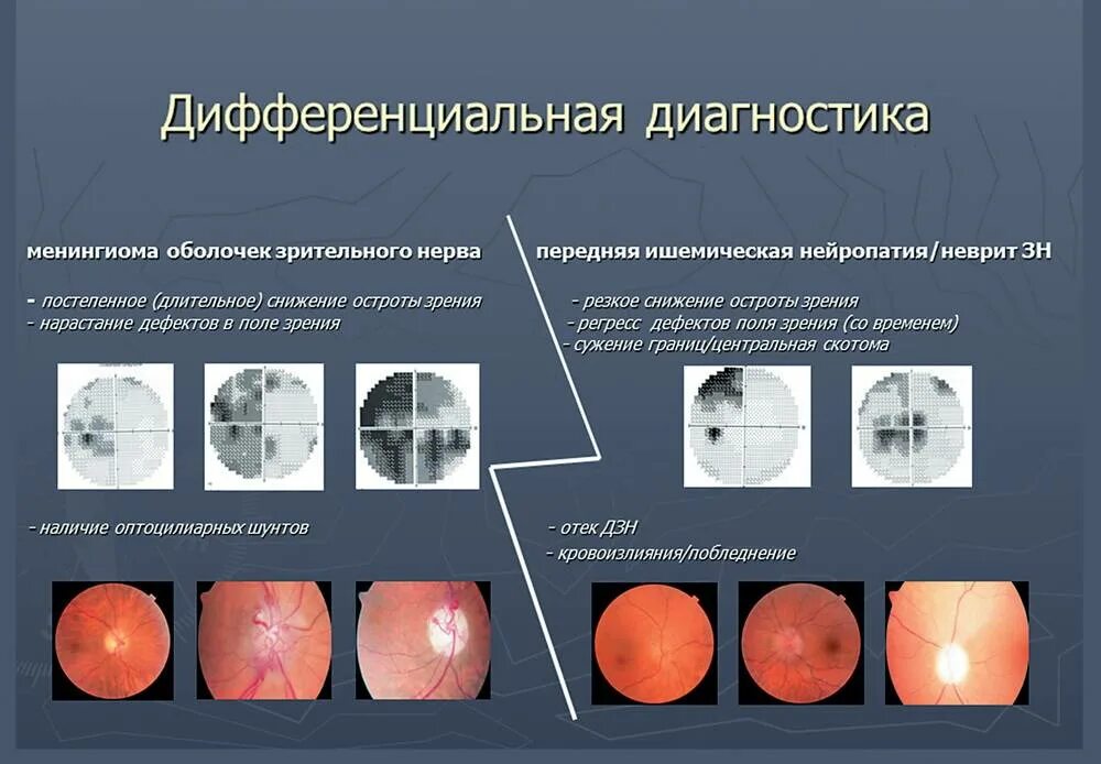 Лечение глазного нерва. Застойный диск зрительного нерва дифференциальная диагностика. Дифференциальный диагноз отслойки сетчатки. Передняя ишемическая оптиконейропатия зрительный нерв. Менингиома зрительного нерва периметрия.