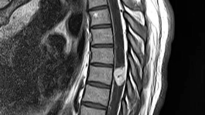 Невринома грудного отдела позвоночника. Гемангиобластома спинного мозга. Интрамедуллярная опухоль спинного мозга мрт. Интрамедуллярная опухоль спинного мозга шейного отдела позвоночника. Интрамедуллярные опухоли спинного