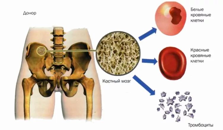 Подвздошная кость костный мозг. Трансплантация клеток костного мозга. Аутологичная трансплантация костного мозга. Пересадка ктстного мтзгс. Пересадка костного мозга что это