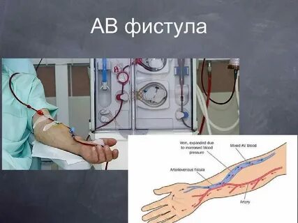 Проктологиядағы фистингтің салдары: фото