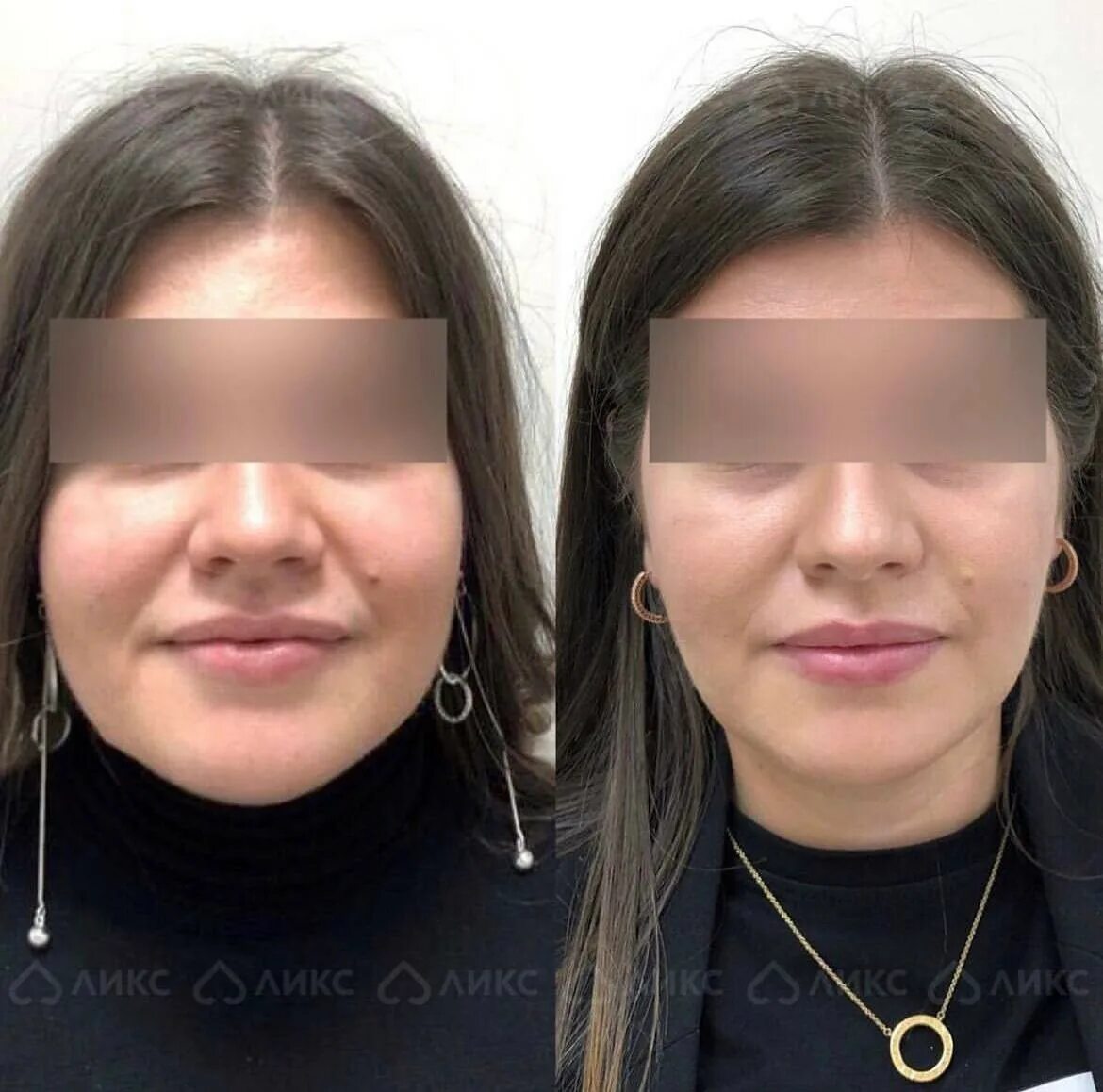 Ботулинотерапия жевательных мышц. Коррекция жевательных мышц. гипертрофия жевательных мышц лица. коррекция жевательных мышц ботулотоксином. коррекция гипертонуса жевательных мышц.