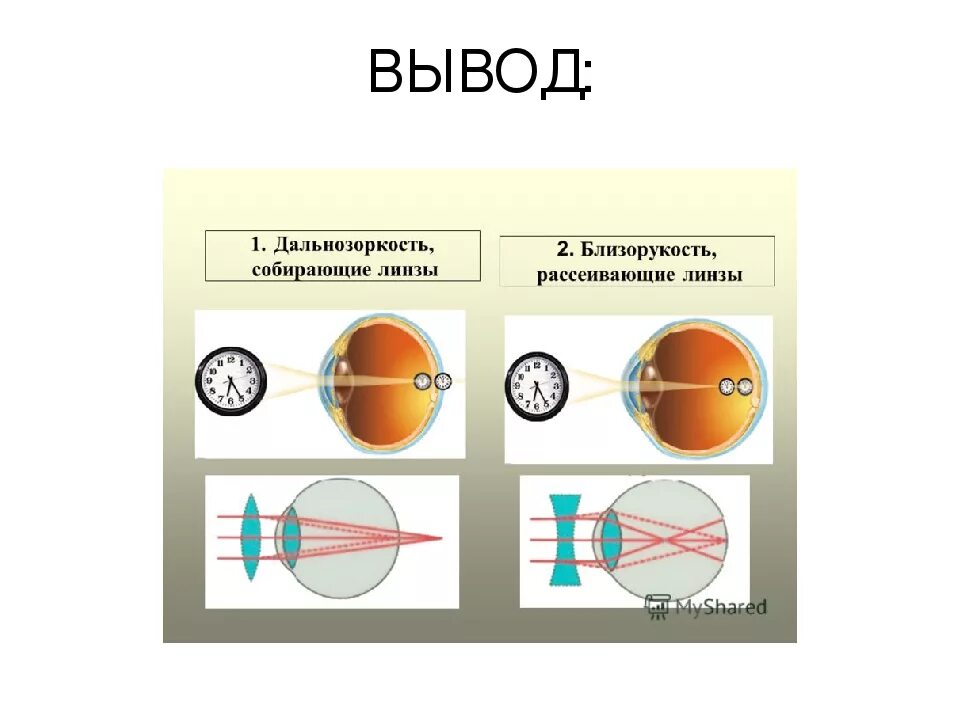 Коррекция зрения с помощью линз. Дефекты зрения близорукость и дальнозоркость. Линзы схема для близорукости и дальнозоркости. Близорукость и дальнозоркость схема физика. Зрение близорукость и дальнозоркость.