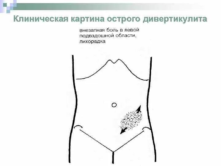 Ноющая боль в подвздошной области. Боли в леыоц подвдршеой обоасти. Боль в левом подвоздошеои области. Ноющие боли в левой подвздошной области. Болит в левой подвздошной области.