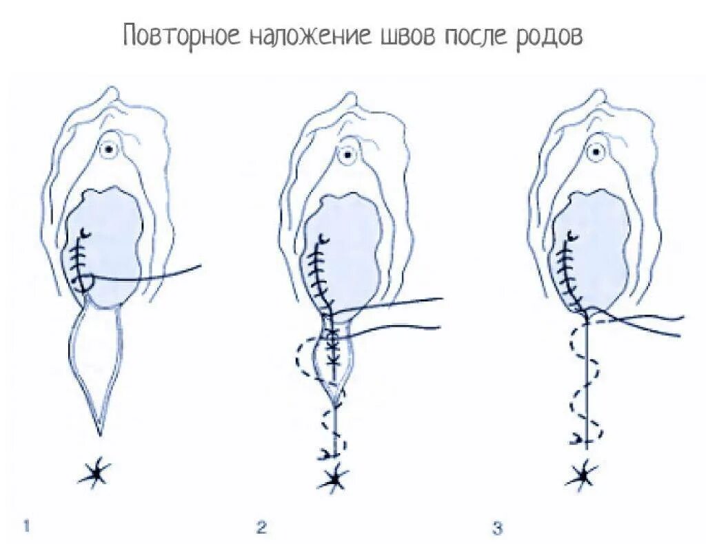 Ушивание разрывов. Зашивание эпизиотомии. Наружные швы после разрыва.