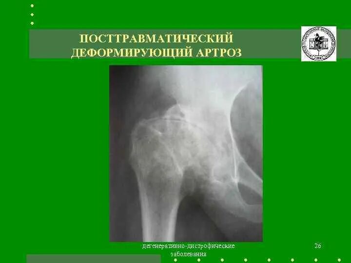 Доа тазобедренного сустава 2 степени. Деформирующий артроз тазобедренного сустава рентген. деформирующий остеоартроз тазобедренного сустава по kellgren. посттравматический артроз тазобедренного сустава рентген. посттравматического остеоартрита..