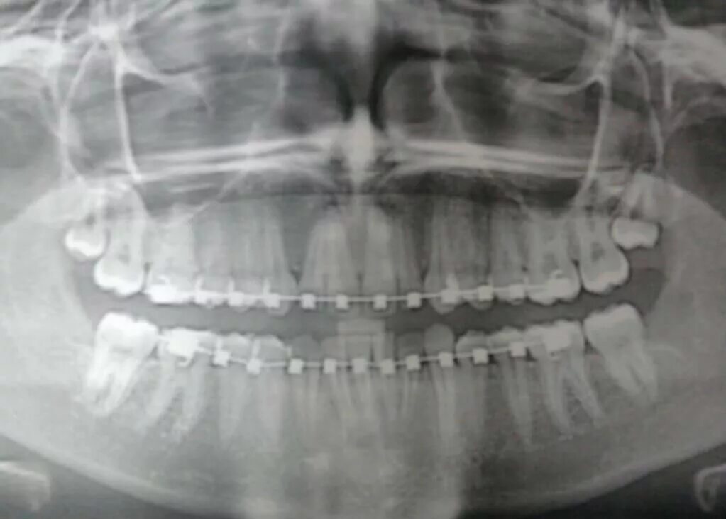 Мрт можно делать с брекетами на зубах. Панорамный снимок зубов с брекетами.