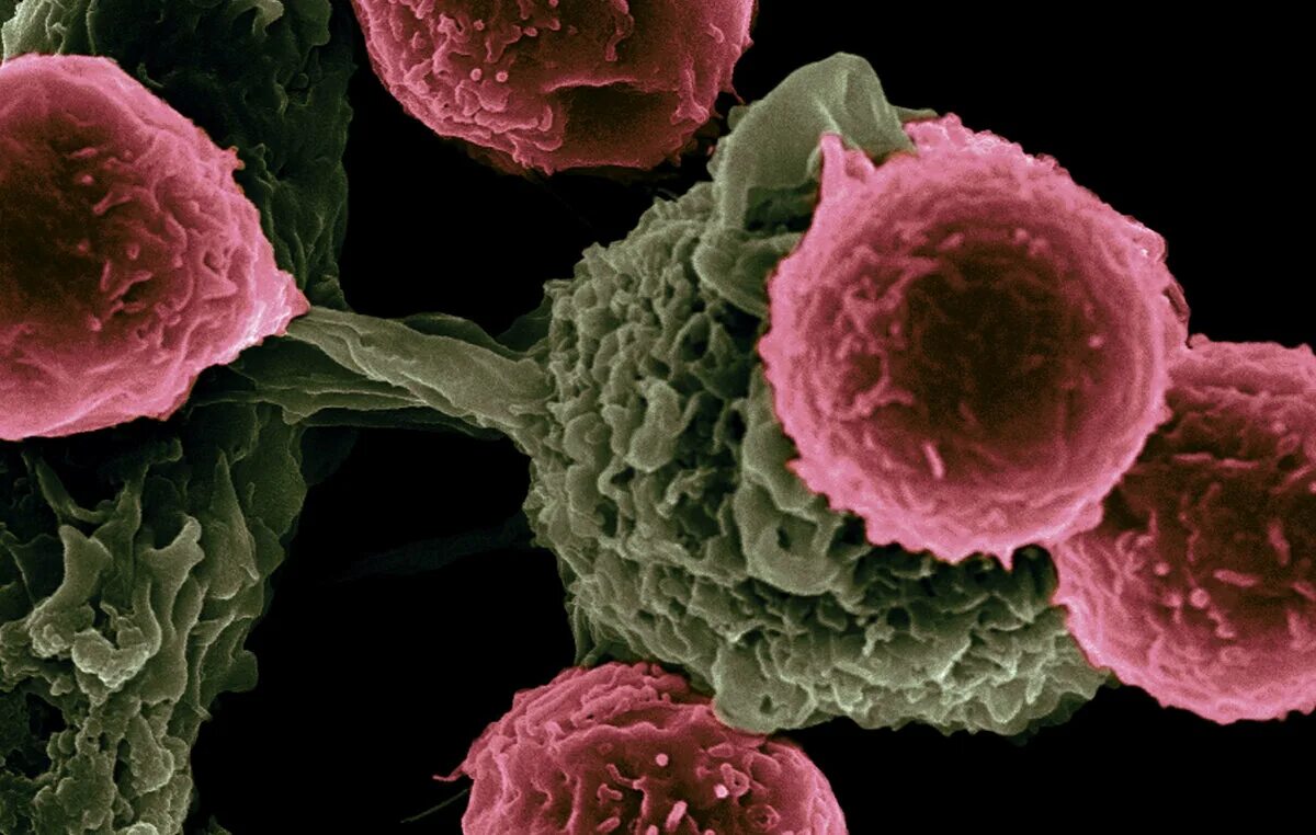 Злокачественная опухоль. Cancer bacteria. Рак поддается лечению