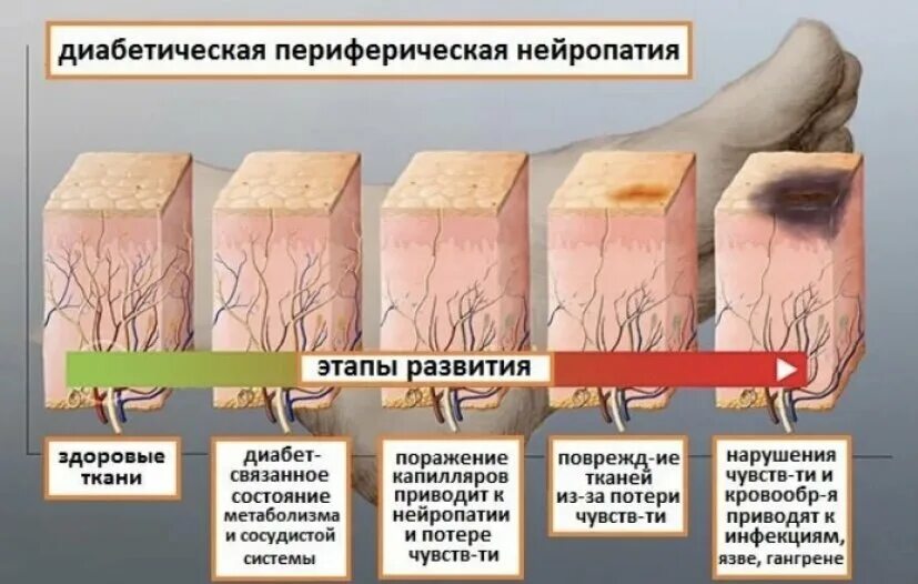 Полинейропатия стоп. Диабетическая периферическая нейропатия. Диабетическая периферическая нейропатия симптомы. Диабетическая полинейропатия нижних конечностей язвы. Диабетическая полинейропатия, диабетическая стопа.