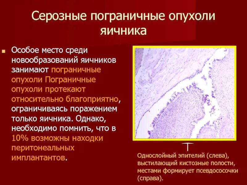 Доброкачественная опухоль яичника клинические. Серозная Пограничная опухоль. Серозная опухоль яичника. Серозные опухоли яичников.