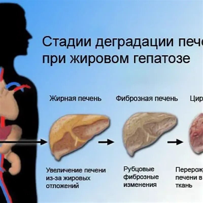 Проблема печени у женщин. Печень при жировом гепатозе. Жировой гепатоз и цирроз. Признаки цирроза печени у женщин.