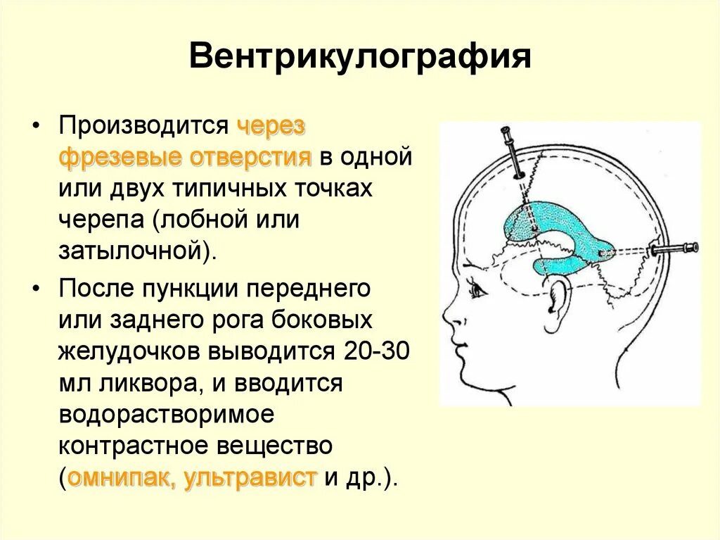 Контрастная вентрикулография. Вентрикулография желудочков мозга. Рентгеноконтрастная вентрикулография.