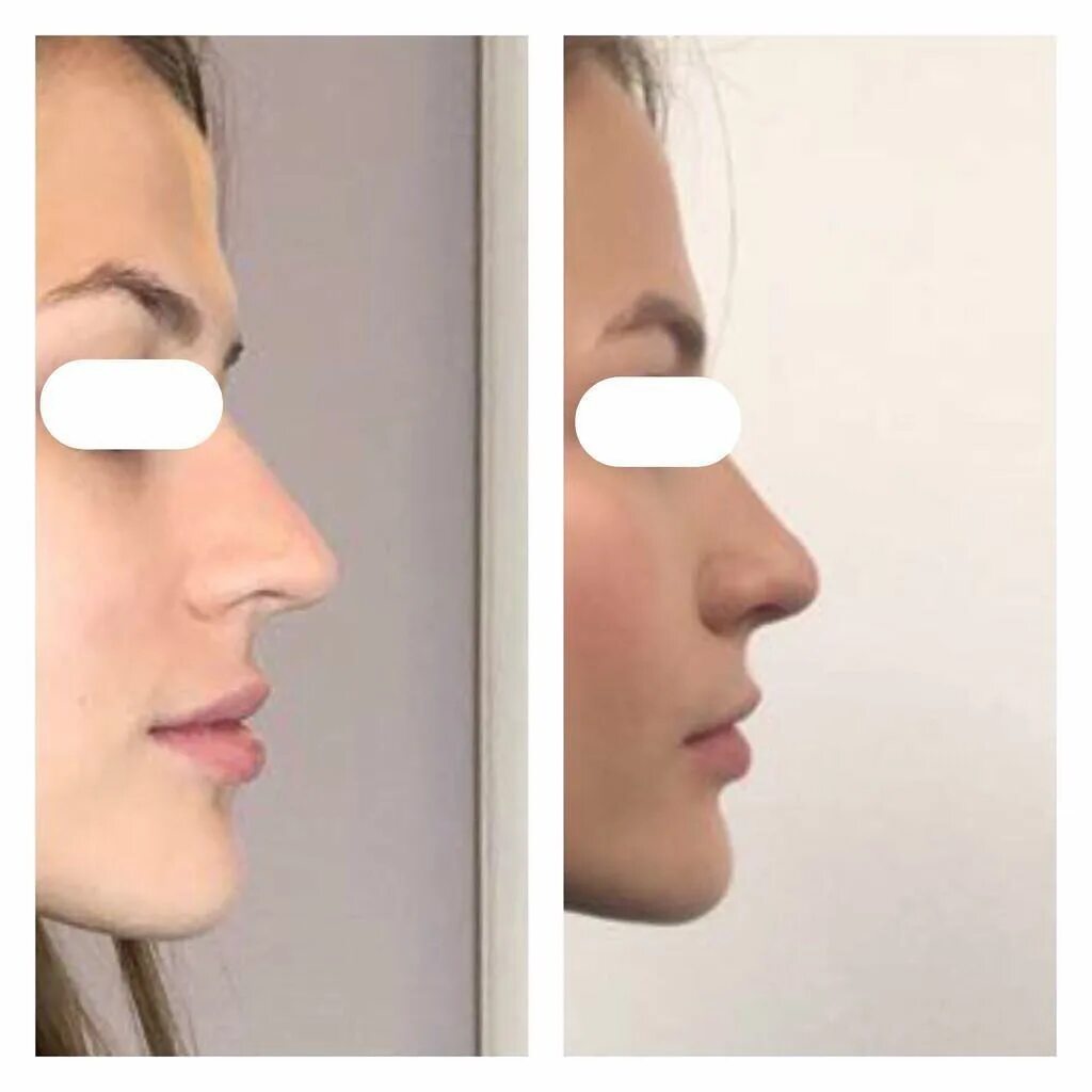 Как уменьшить ноздри. Массаж для уменьшения носа. Макияж носа. Упражнения для уменьшения носа до и после. Как уменьшить ноздри.