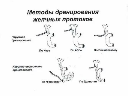 Дренирование желчных протоков