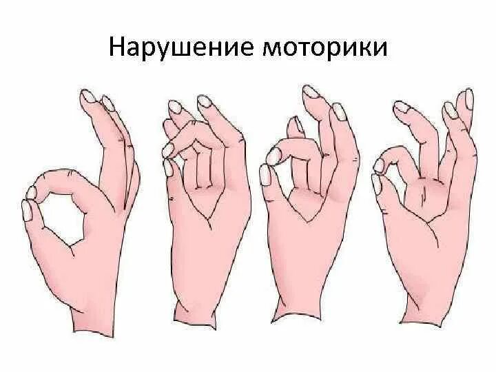Нарушение движения рук. Нарушение моторики. нарушение произвольной моторики. праксис позы пальцев рук для детей. упражнения для пальцевого праксиса.