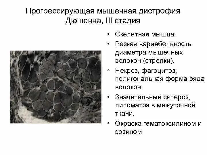 Прогрессирующая мышечная дистрофия тест нмо. Мышечные дистрофии классификация. прогрессирующие мышечные дистрофии неврология. дистрофия мышечных волокон.