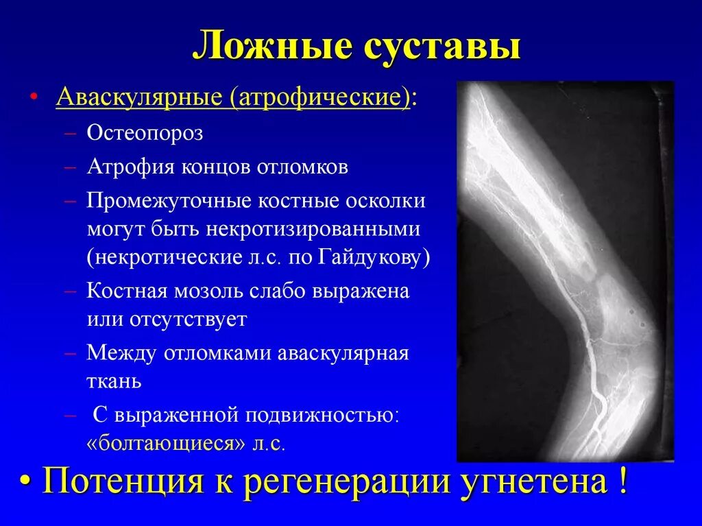 Рентгенологически ложный сустав. Формирование ложного сустава на кт. Ложный сустав плечевой кости на кт. Ложный сустав большеберцовой кости.
