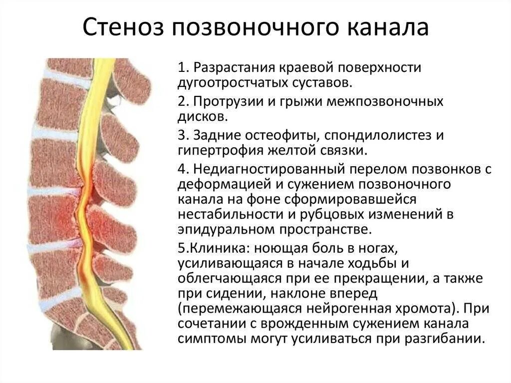 Как лечить стеноз шеи. Стеноз позвоночного канала l2-l3. вторичный стеноз позвоночного канала поясничного. стеноз межпозвонковых отверстий l2-s1. дегенеративный спинальный стеноз l3-l4.