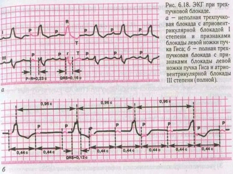 Блокада пучка гиса на экг у ребенка. Блокада ЛНПГ на ЭКГ. Блокада левой ножки пучка Гиса на ЭКГ. Блокады ветвей пучка Гиса на ЭКГ. Трехпучковая блокада ножек пучка Гиса на ЭКГ.