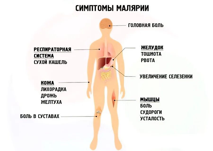 Малярия симптомы и лечение у взрослых. Признаки малярии у человека симптомы. основные симптомы малярии.