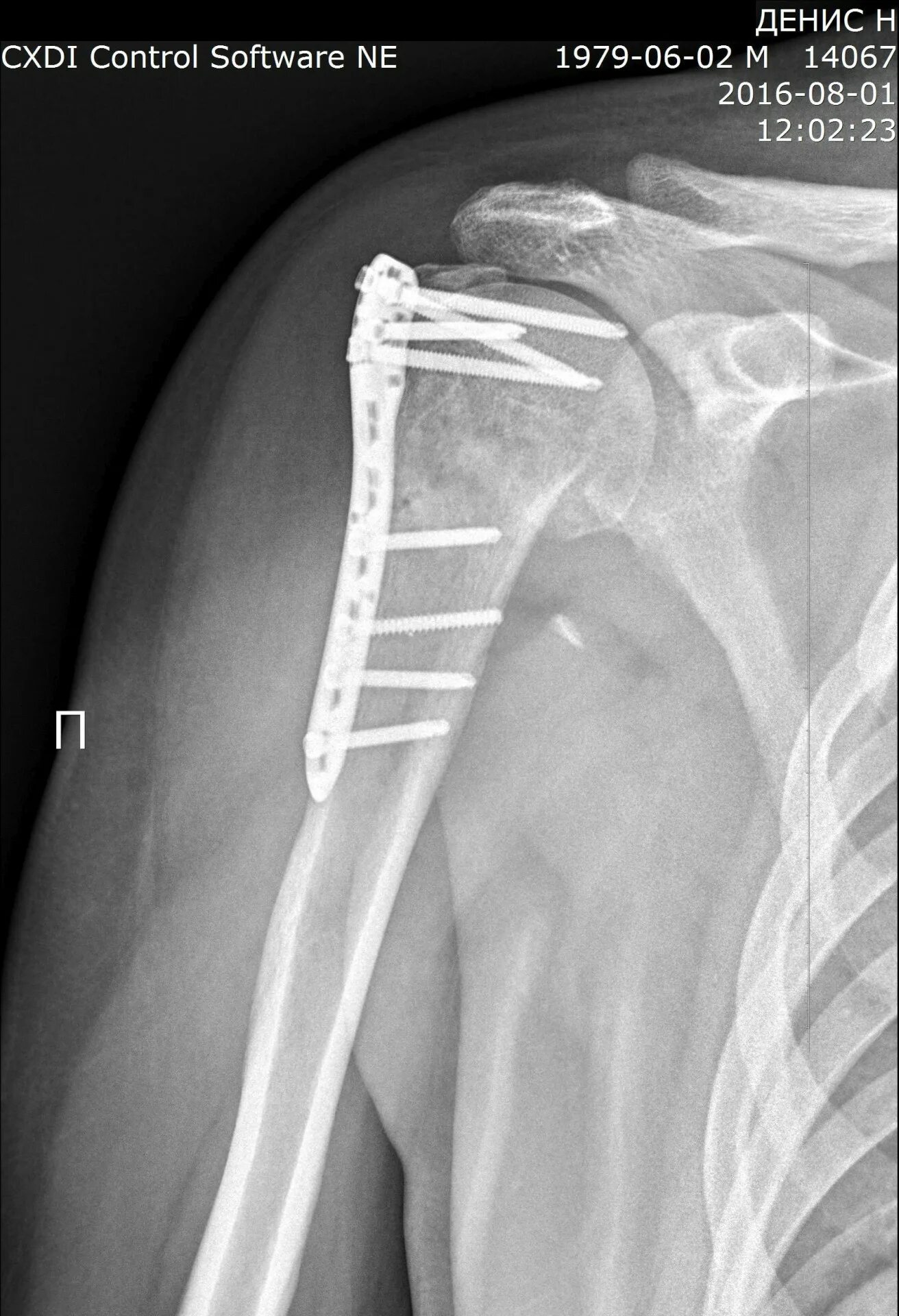 File:FractureTrochanter.png - Wikipedia
