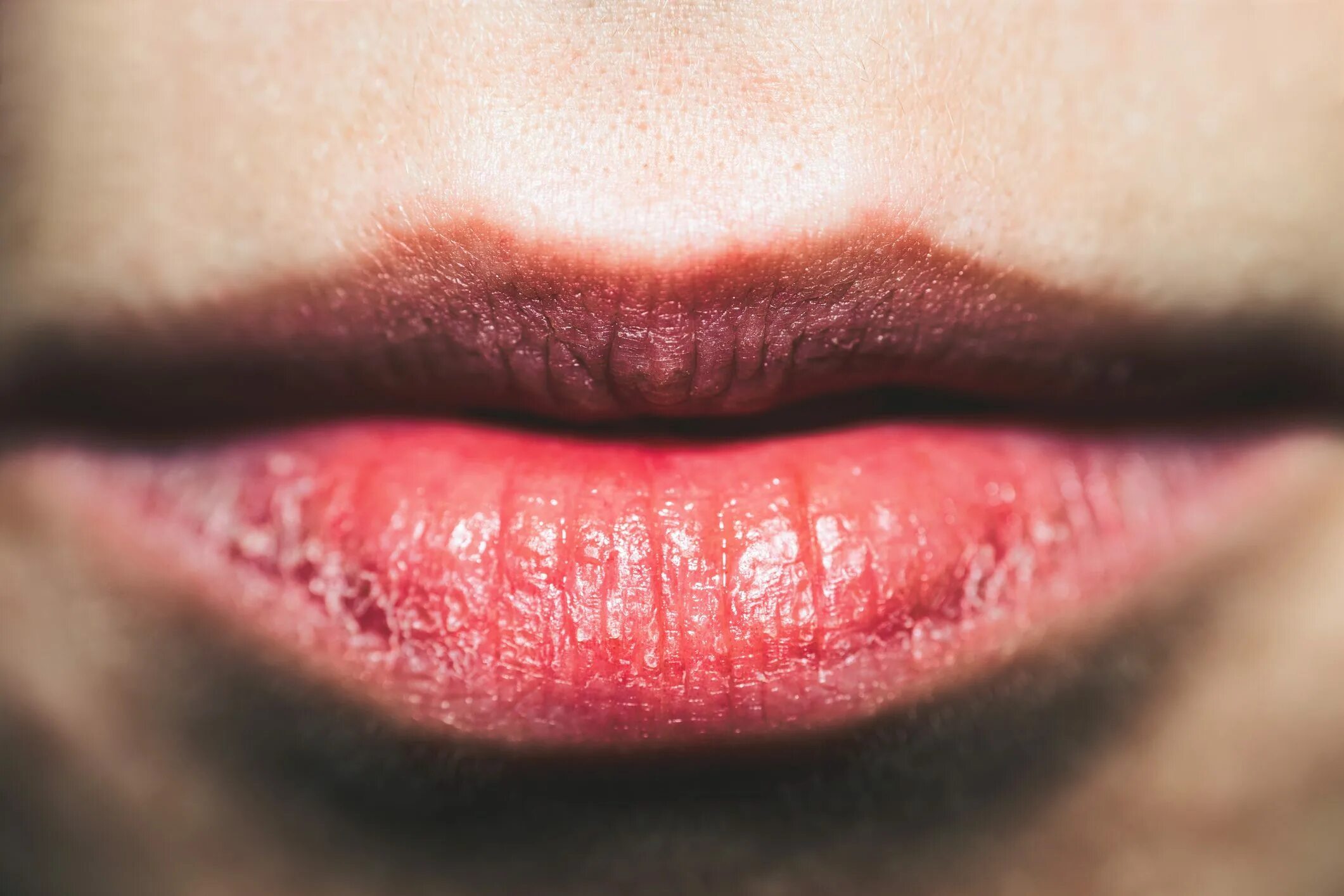 Сильно обветренные губы. Абразивный хейлит Манганотти.
