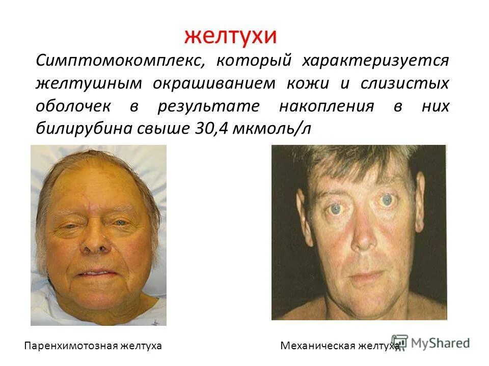 желтуха цвет кожных покровов. почему человек становится желтым. синдром жильбера желтуха. желтушность (склер, слизистых оболочек, кожных покровов). почему человек становится желтым.