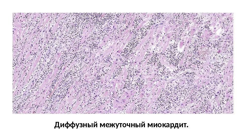 Умеренный фон диффузных изменений
