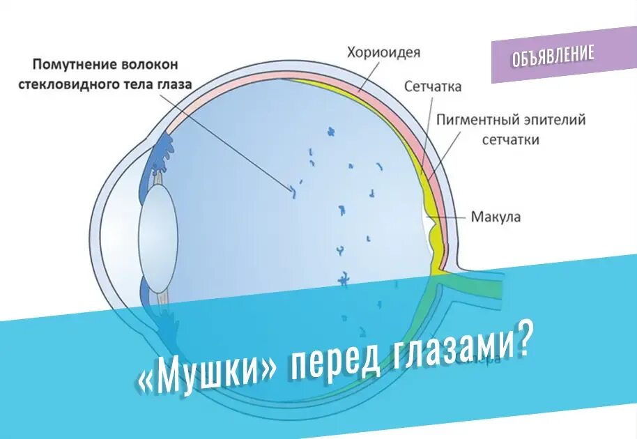 Строение стекловидного тела глаза. Структура стекловидного тела. Помутнение стекловидного тела. Канал стекловидного тела. Прозрачное тело в глазу