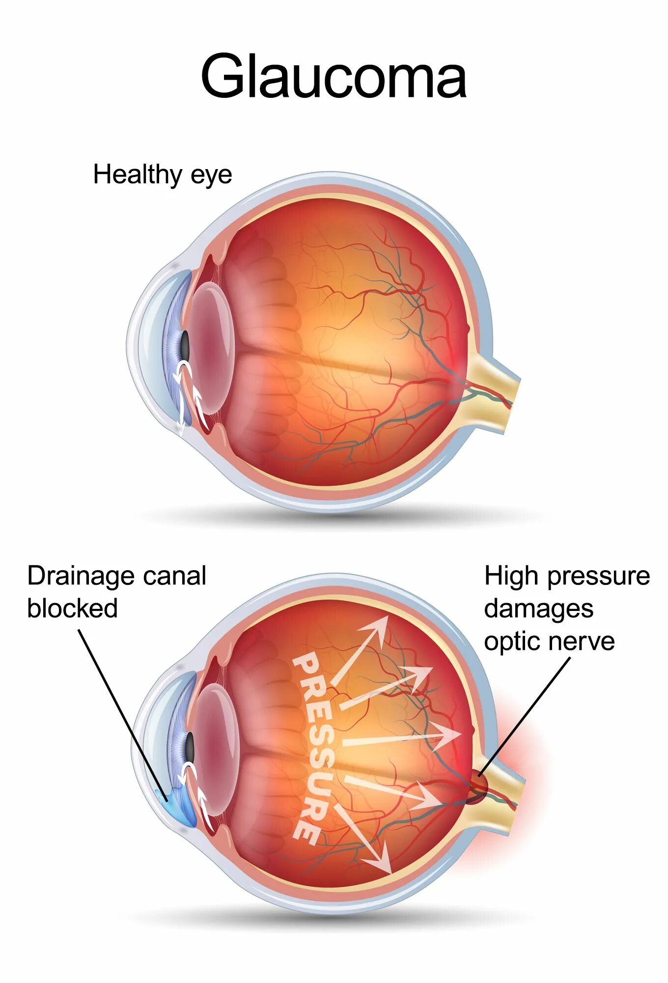 Что делать при глаукоме глаза. Терминальная глаукома.