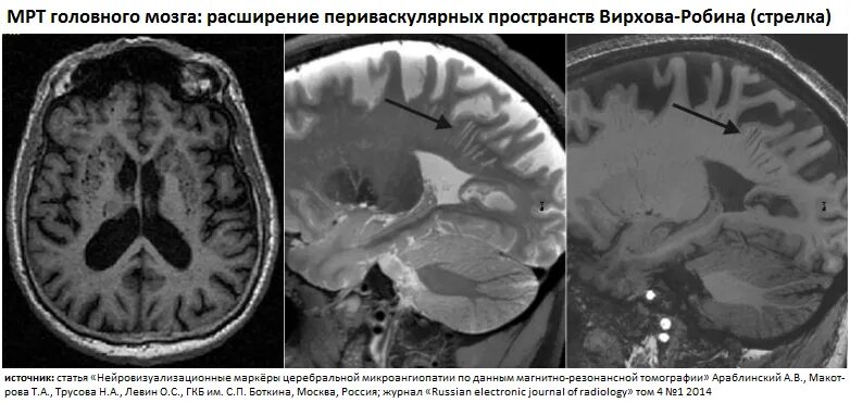 Периваскулярные пространства Вирхова-Робина мрт головного мозга. Периваскулярные пространства Вирхова-Робина расширены. Пространства Робина Вирхова на кт. Пространство Вирхова-Робина расширены кт. Постишемические изменения мозга