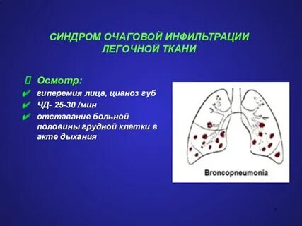 Очаговая инфильтрация легочной ткани