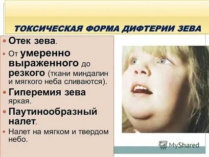 Инфекционный мононуклеоз мкб 10 код у детей
