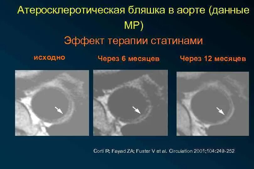 Атеросклеротическая бляшка узи. Атеросклеротическая бляшка аорты. изоэхогенная атеросклеротическая бляшка.