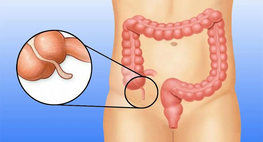 Колики аппендицит. Аппендикс это отросток слепой кишки. Червеобразный отросток слепой кишки. Червеобразный отросток аппендикс лапароскопически.