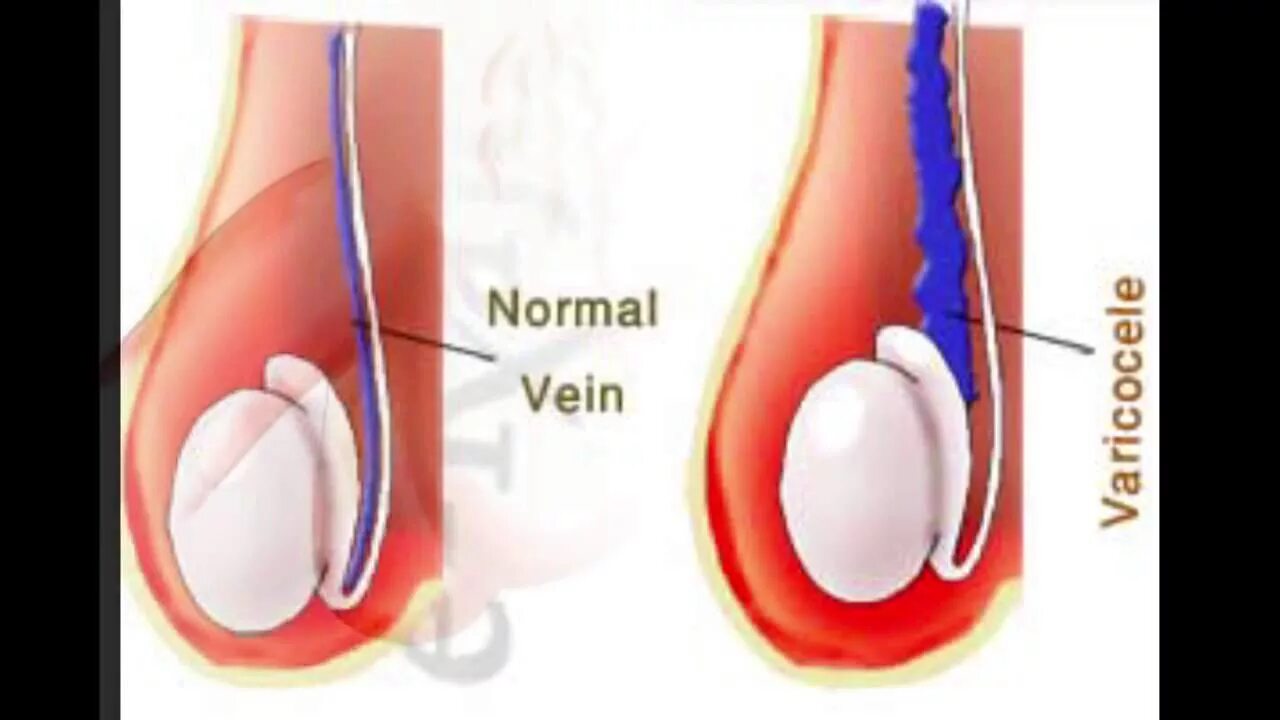 Варикозное расширение семенного канатика. Варикоцеле расширение вен. Расширенная Вена в яичке. Холодные яйца у мужчины