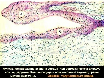 Мукоидное набухание это