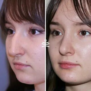 Софья хилькова пластика носа до и после фото - PwCalc.ru